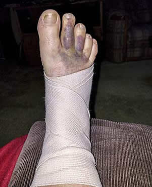 Bruised foot after ankle break
